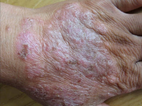 长沙鸿业皮肤病专科医院曝光:重度湿疹反反复复?积极治疗获健康!