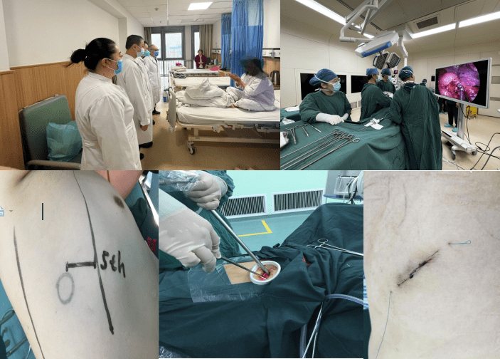 北大医院胸外科专家龙志强来院并完成三例单孔胸腔镜肺癌根治术
