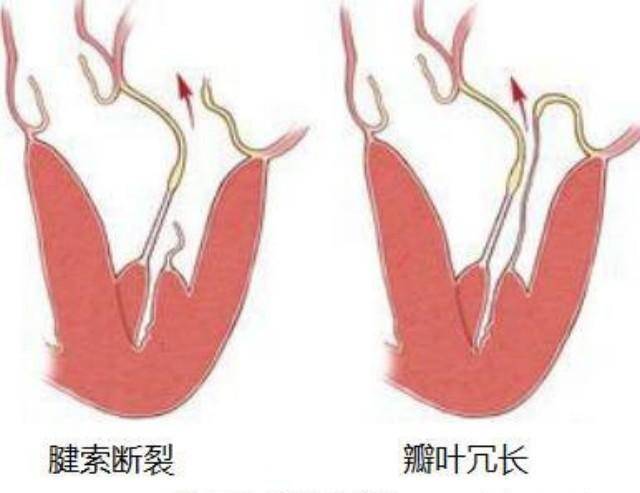 二尖瓣,三尖瓣轻度返流,是啥意思?要治疗吗?
