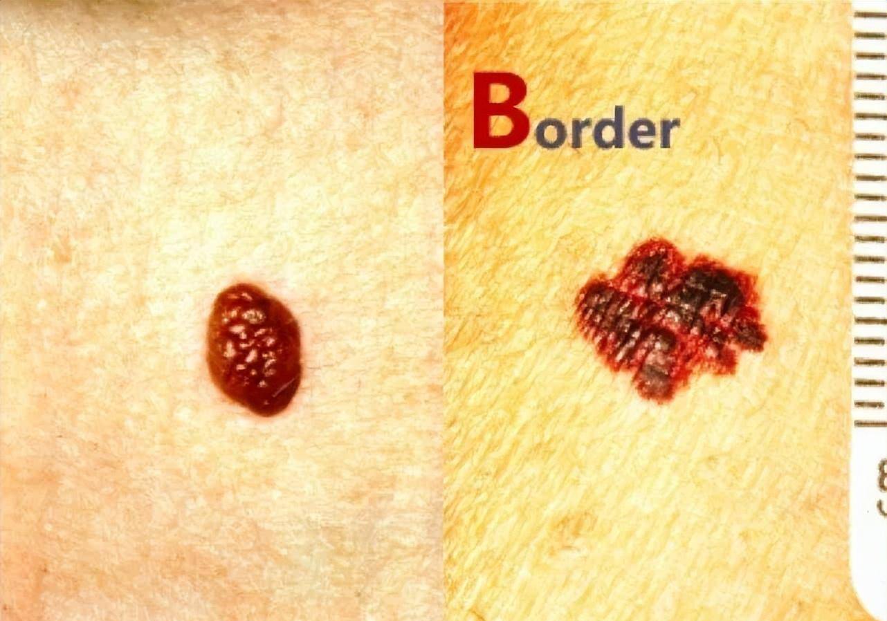 孩子身上的胎记和痣,如果长成这样,赶紧看医生!_部位_影响_发生率