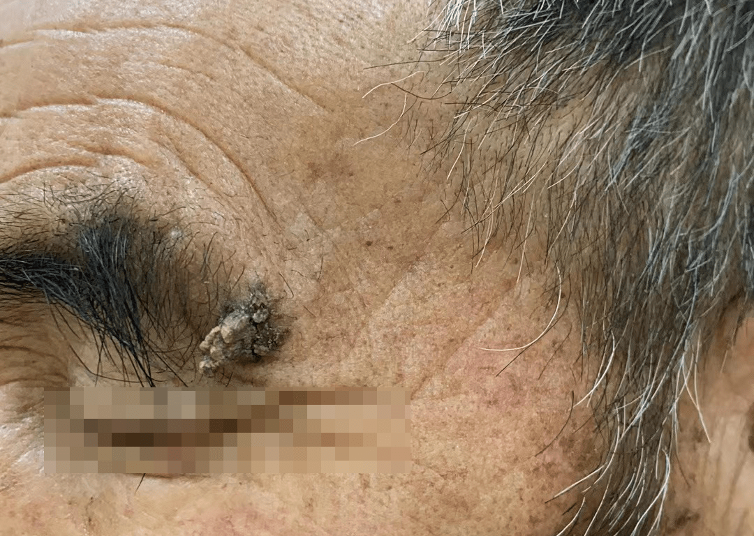 老汉头上"长犄角"医生:其实是皮肤病_皮角_王大爷_冯登超