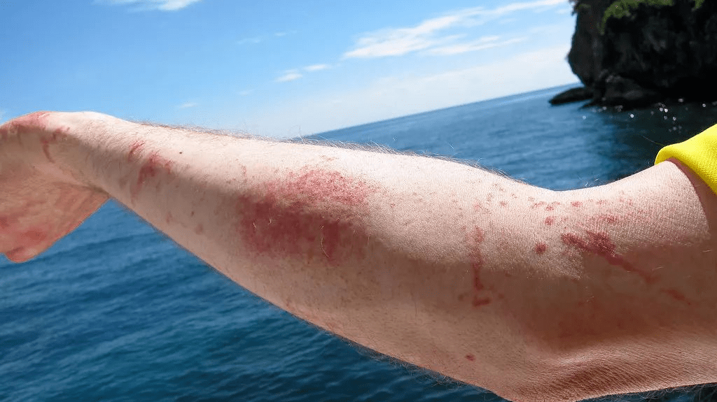 同样"四处游荡"的还有海蜇:被沙海蜇和海蜇咬伤后,伤口处会出现红斑的