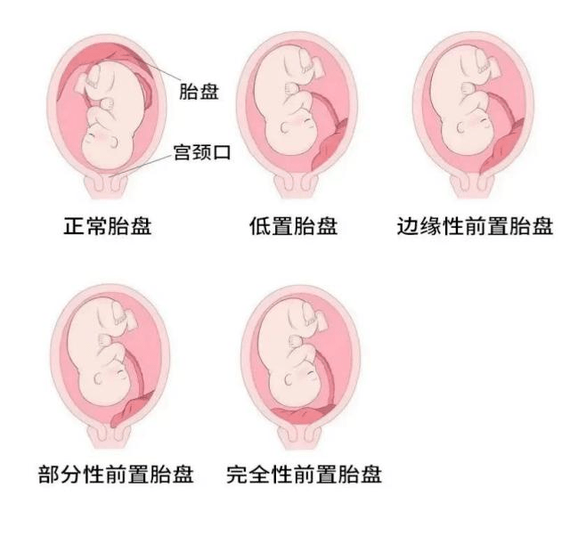 遭遇前置胎盘,孕妈妈应该怎么办?