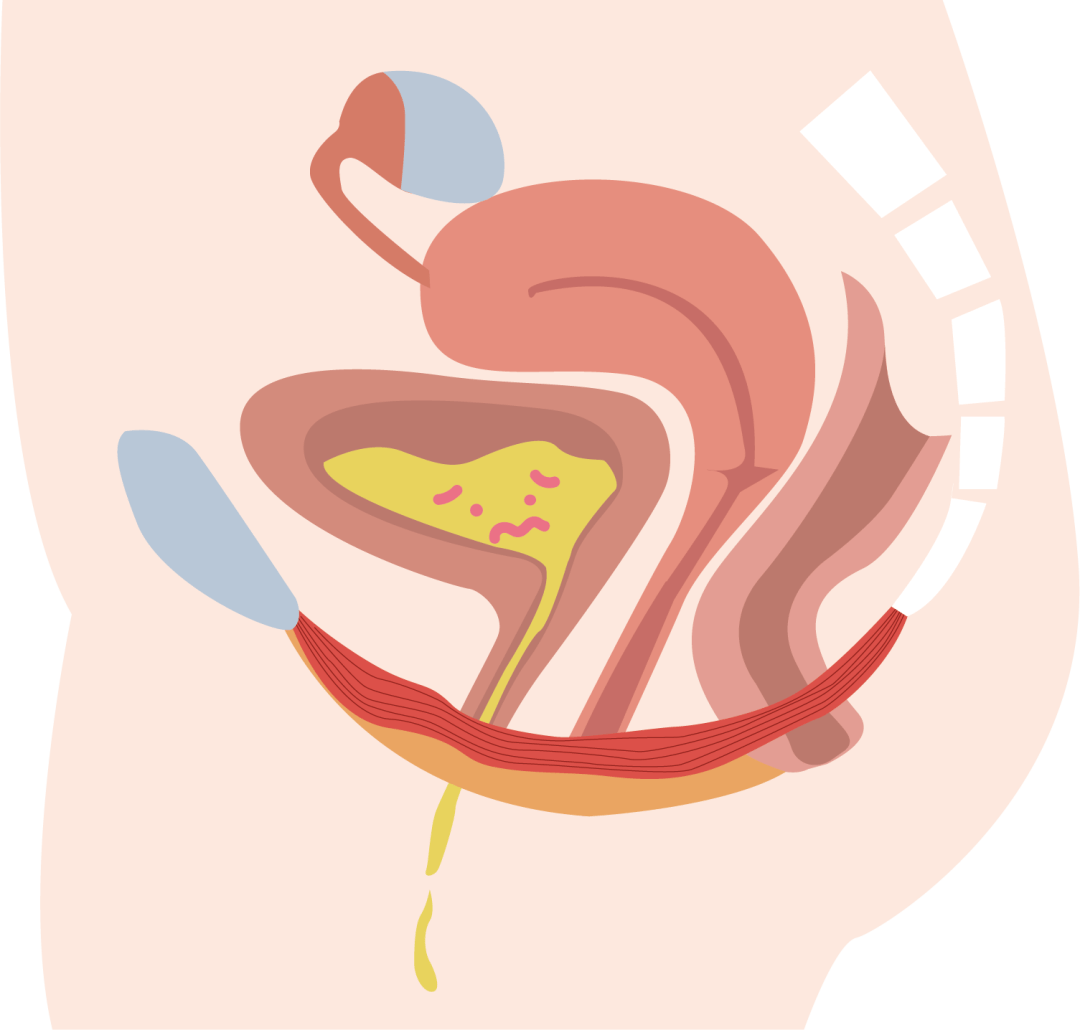 慈溪艾博尔:"一咳就漏",中老年女性面临怎样的"盆底危机"?