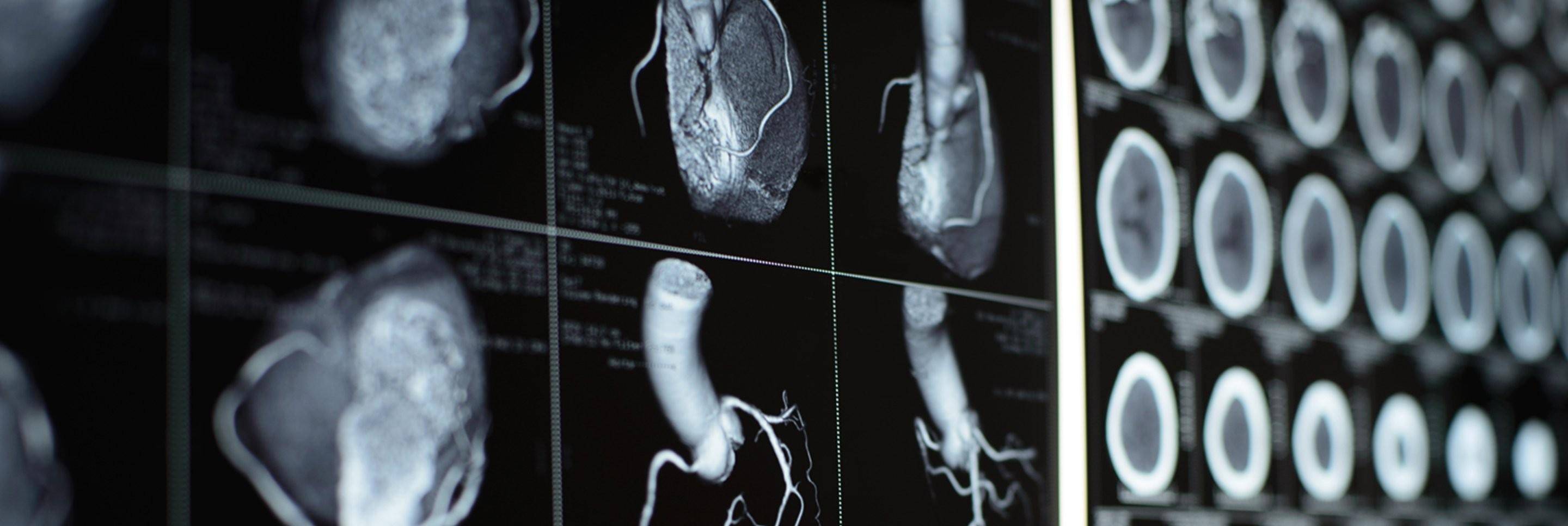 冠脉cta结果显示,在他的"前降支"与"右冠状动脉"这两根主要的冠脉血管