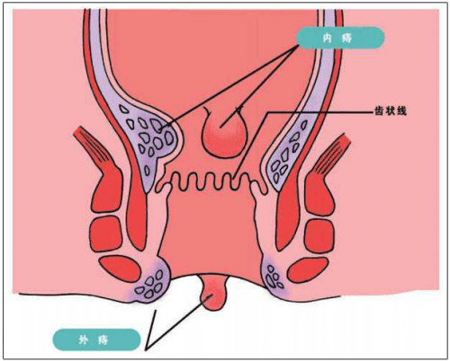 因此通過提肛運動可以起到促進肛周血液循環的作用,從而預防痔瘡.