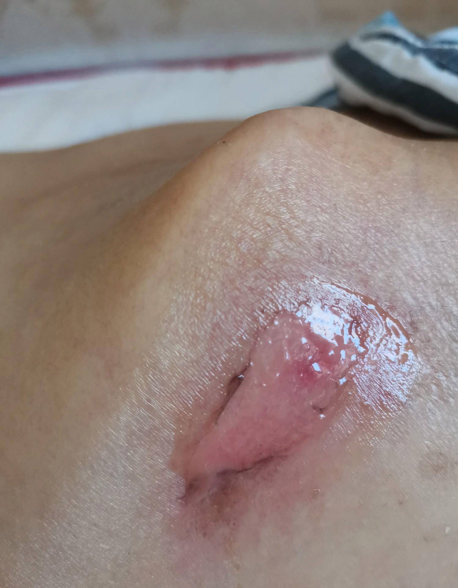 肛瘘术后伤口感染照片图片