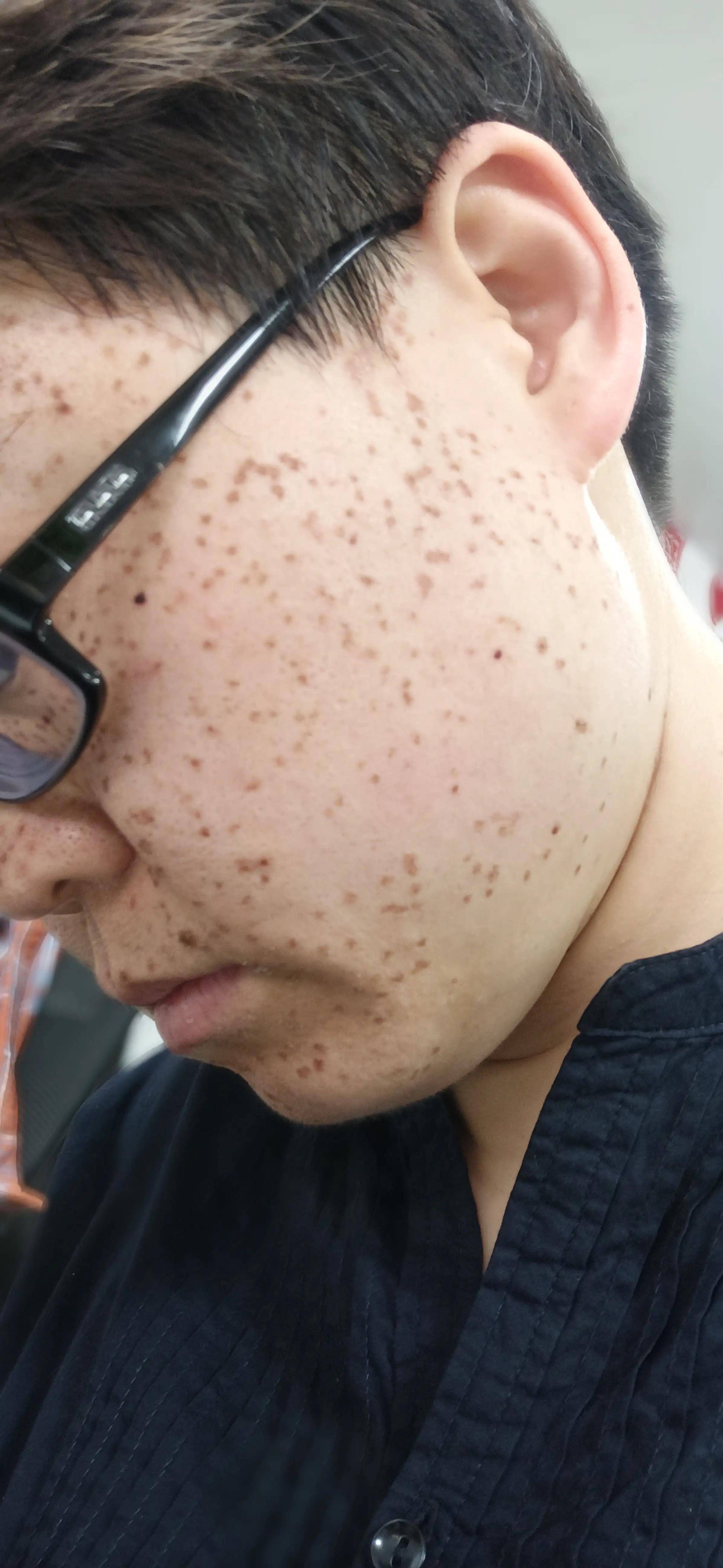 嘴巴_麻子_因为