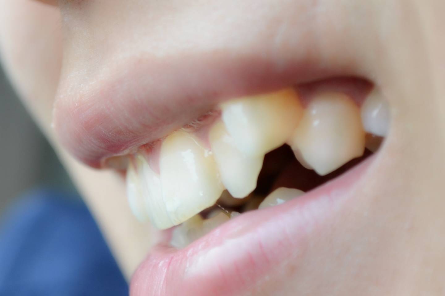 原创            拔智齿后牙齿真的会变松吗？什么样的智齿必须拔？一次性说清楚-拔了智齿牙齿会变整齐吗