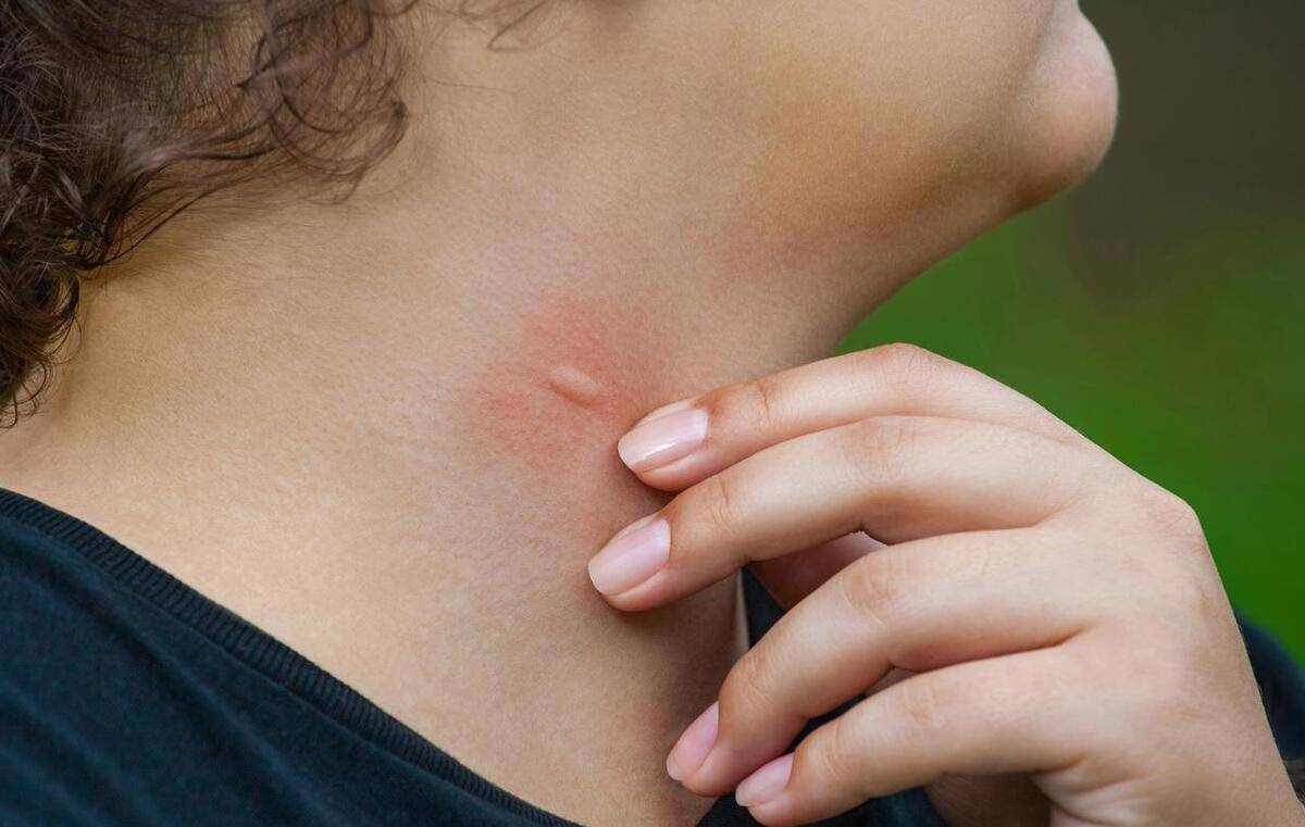 蚊子包为什么越挠越痒,怎么判断是不是蚊子包?