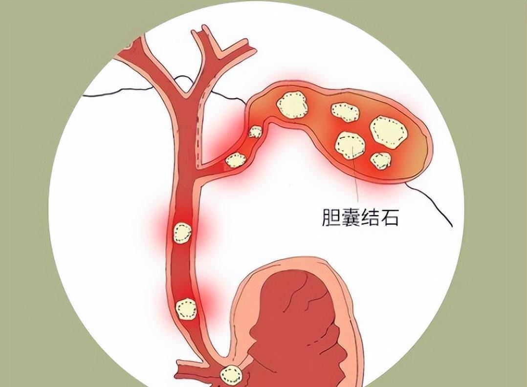 治疗急性胆囊炎首选替代治疗方法