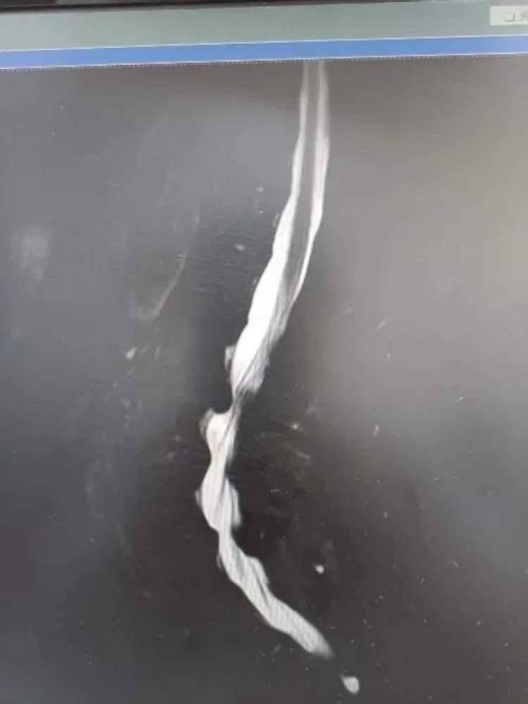多科联合手术，成功治疗严重腰椎间盘突出症-多节腰椎间盘突出手术