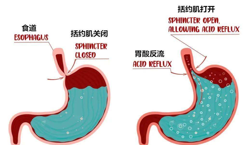 幽门梗阻的症状及治疗图片