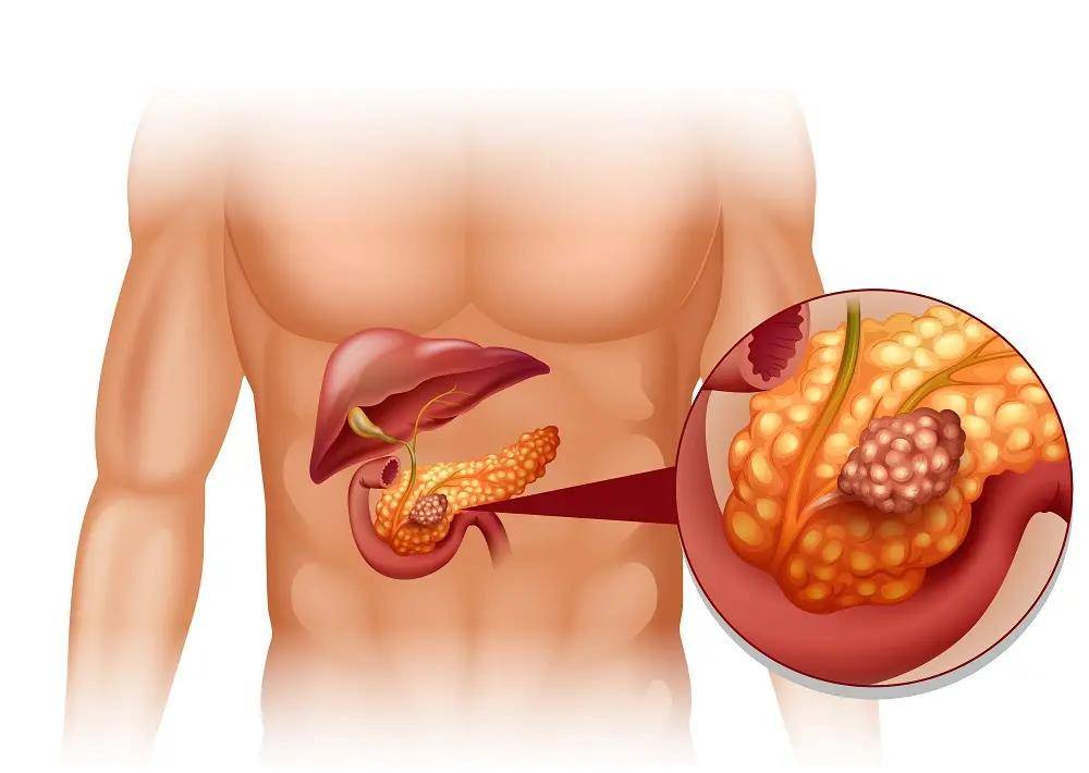 胰腺癌来临时,身体可能会出现4个异常,不要总忽略