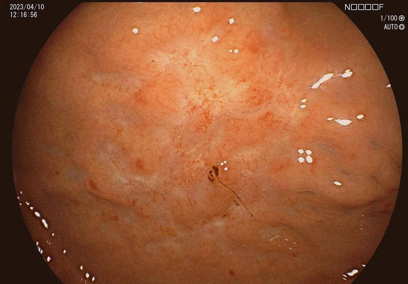 胃淋巴瘤病变较2月前变平,变淡白光模式,中央凹陷,周边黏膜反应性隆起