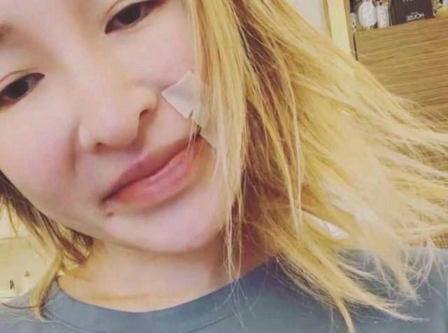 萧亚轩发脸部疤痕照,被爱犬咬伤后的恢复情况,并不理想_状态_伤痕