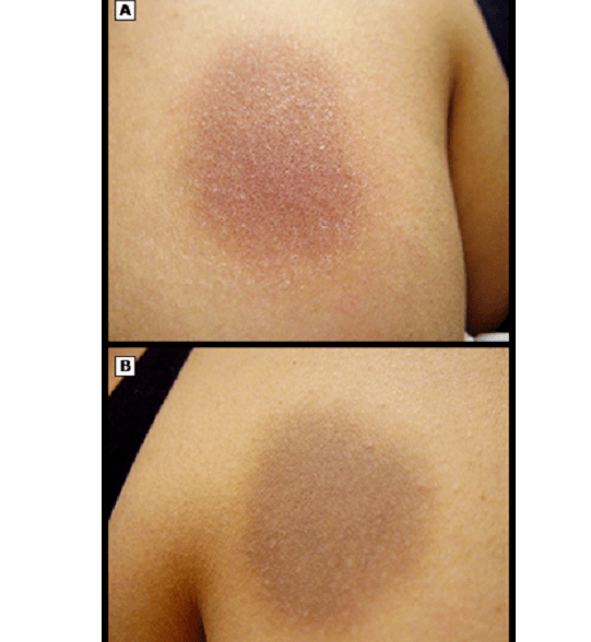 炎症后色素沉着,表皮斑 or 真皮斑?_皮肤_外伤_患者