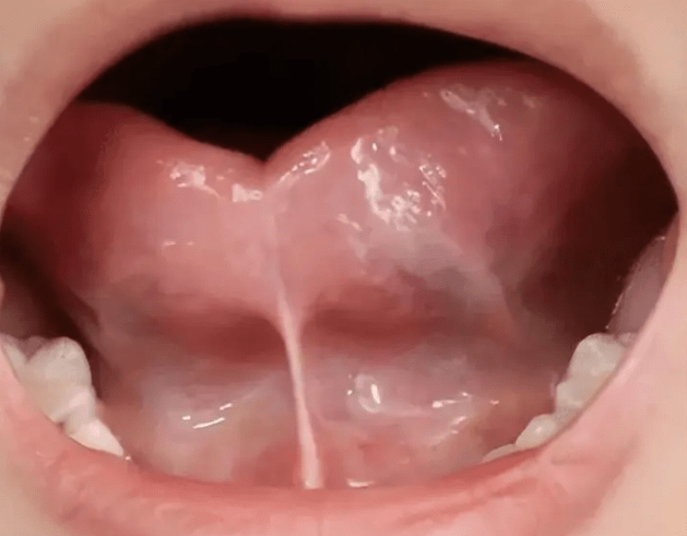 原创舌系手术是怎么做的剪舌系带之前要做哪些准备