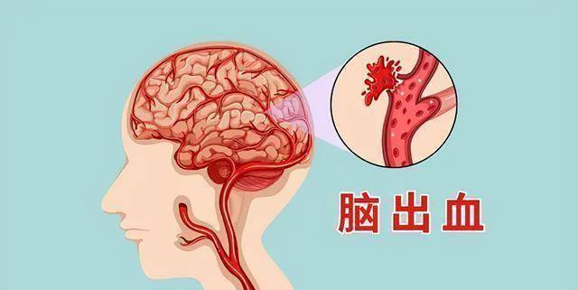脑溢血_情况_姜受延