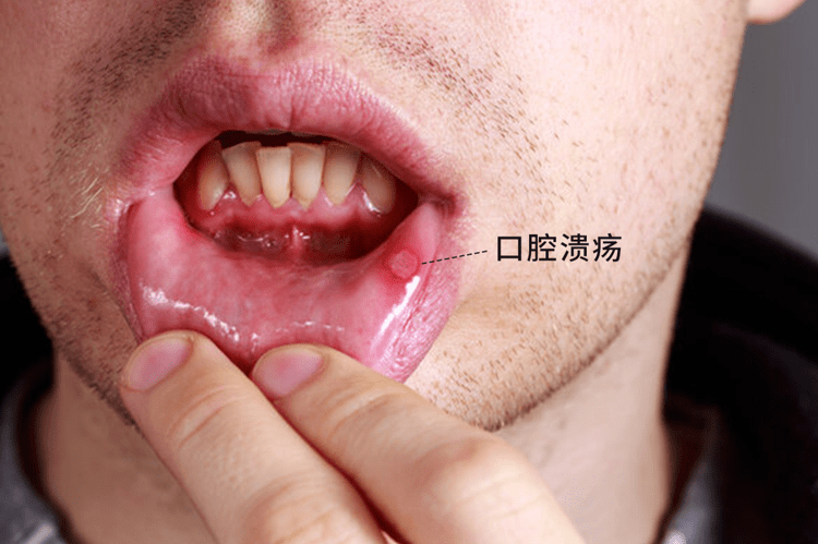 舌边缘溃疡要警惕 来自搜狐网