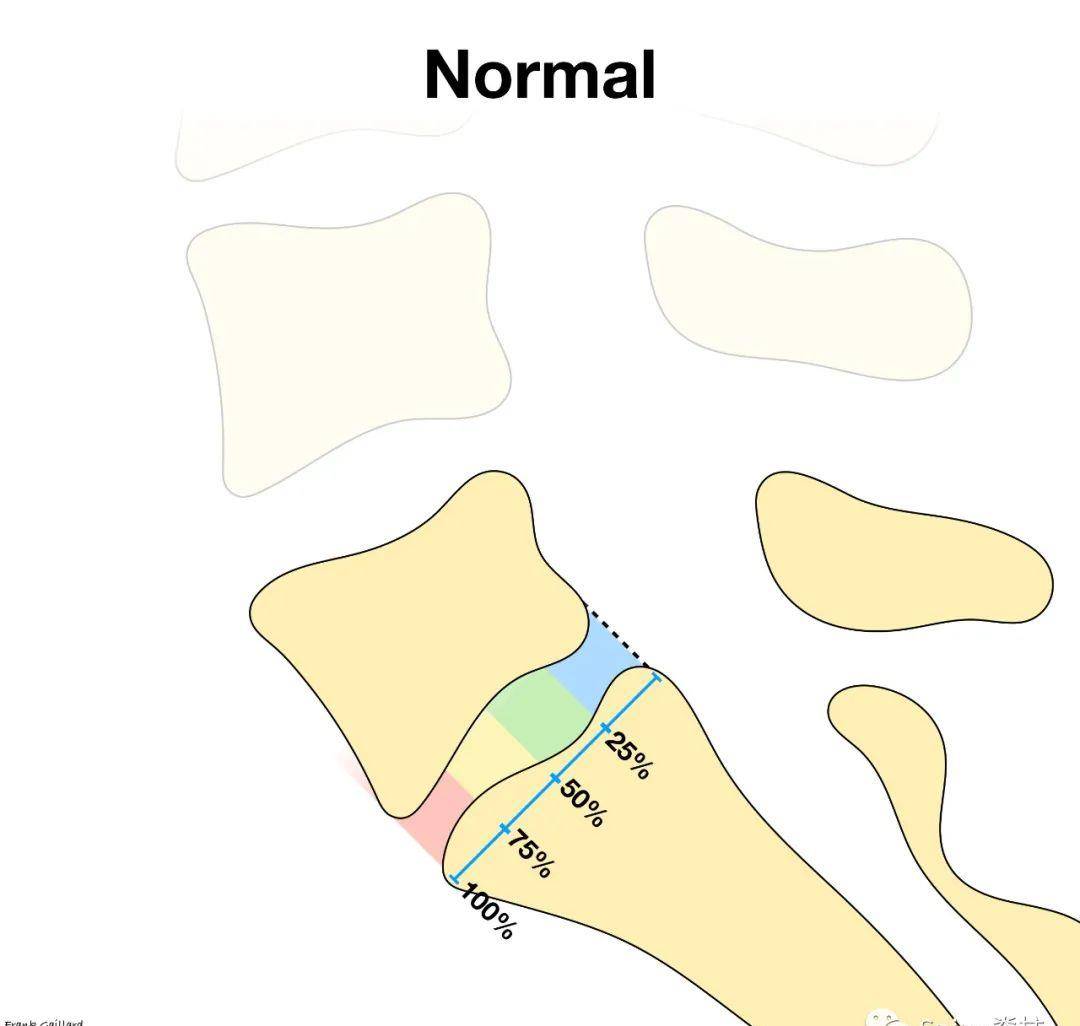 腰椎滑脱meyerding分级_系统_梅奥诊所_henry