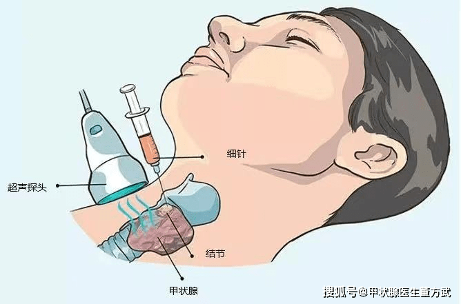 甲状腺结节健康科普（甲状腺结节的健康指导内容）