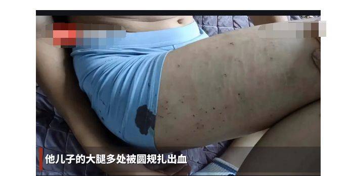 男生遭同学欺负大腿被圆规扎出血 不小心被尖锐物品扎伤出血怎么办