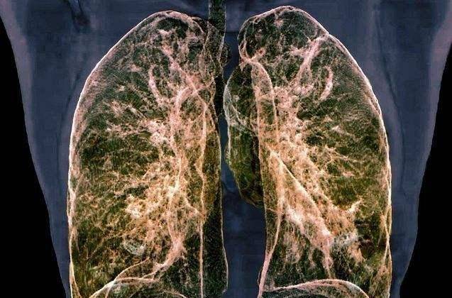 肺好的人,身体3个现象较明显,常做3件事,把肺养得白白净净_肺部_运动