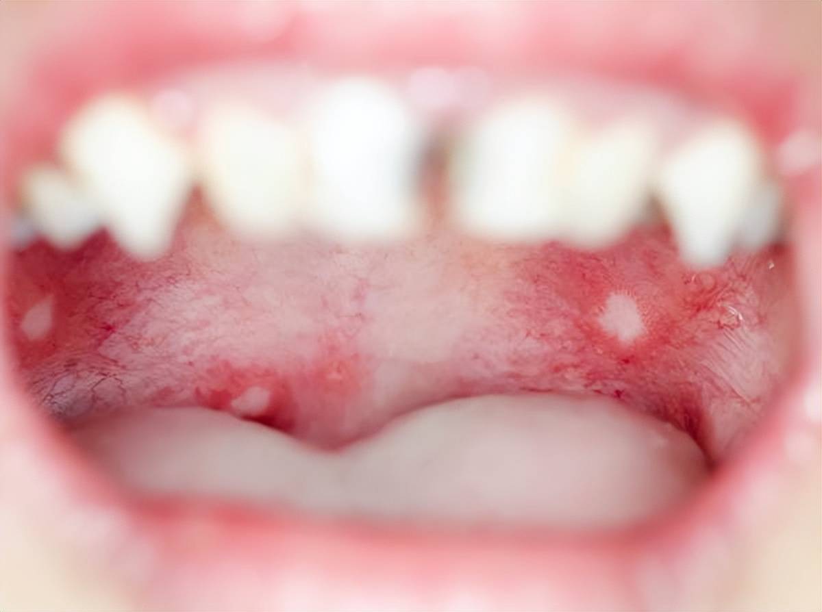 舌头口腔溃疡怎么回事图片