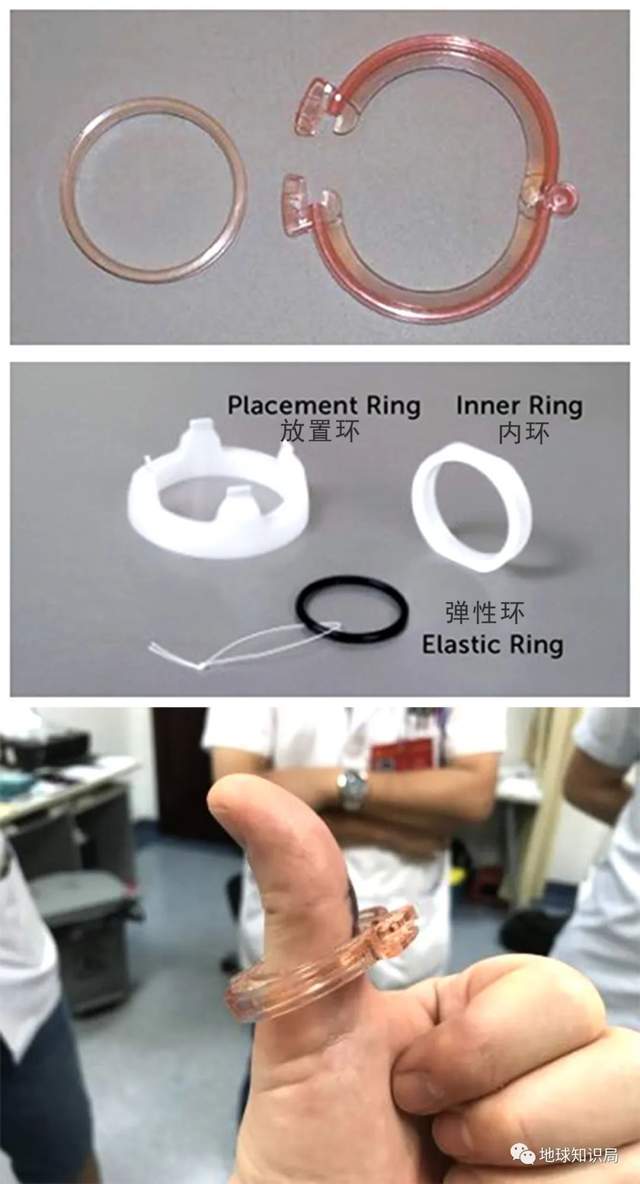 套环手术操作简单,时间也短,术后外观也比较统一,规整.