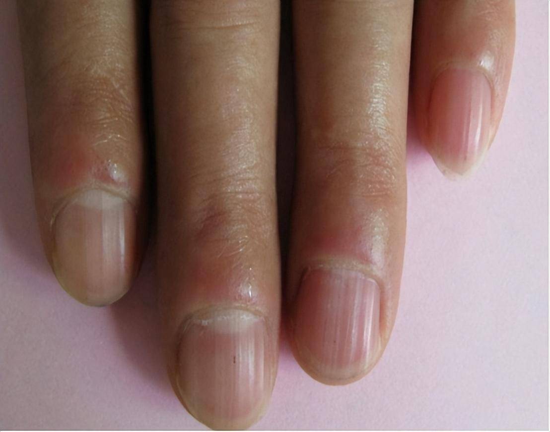 指甲若长成3种样子,可能是癌或疾病的信号,要引起重视