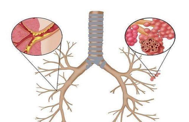 肺气肿的并发症都有哪些得了肺气肿一定要及时就医_阻塞性_检查_降低