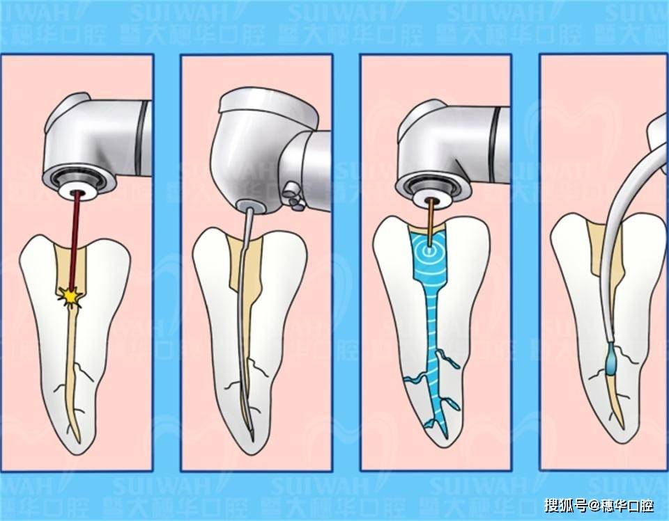 做牙冠的过程图解图片