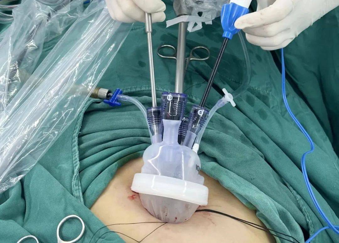 妇科腹腔镜切口位置图片