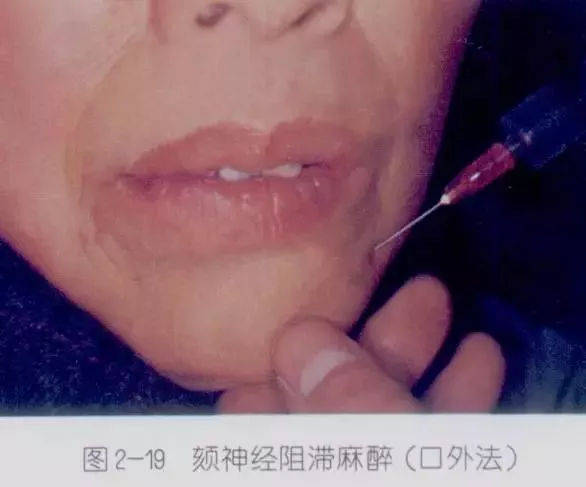 口腔医师必须知道的麻醉方法,麻醉药物及注意事项!_临床_作用_局部