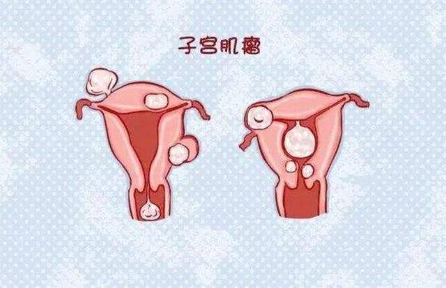 沒了子宮的女人,和正常女性有啥不同?