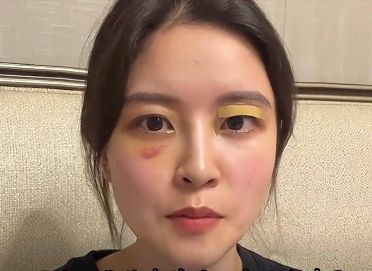 为李玟发声后鼻青脸肿?