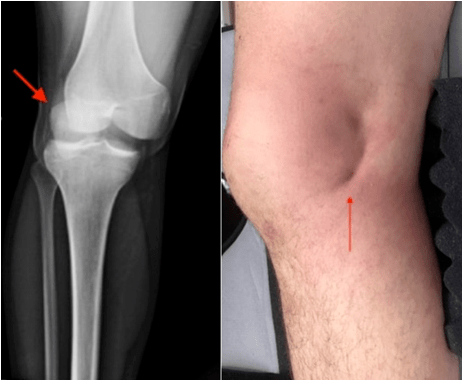 膝关节脱位的临床表现和康复_损伤_韧带_血管