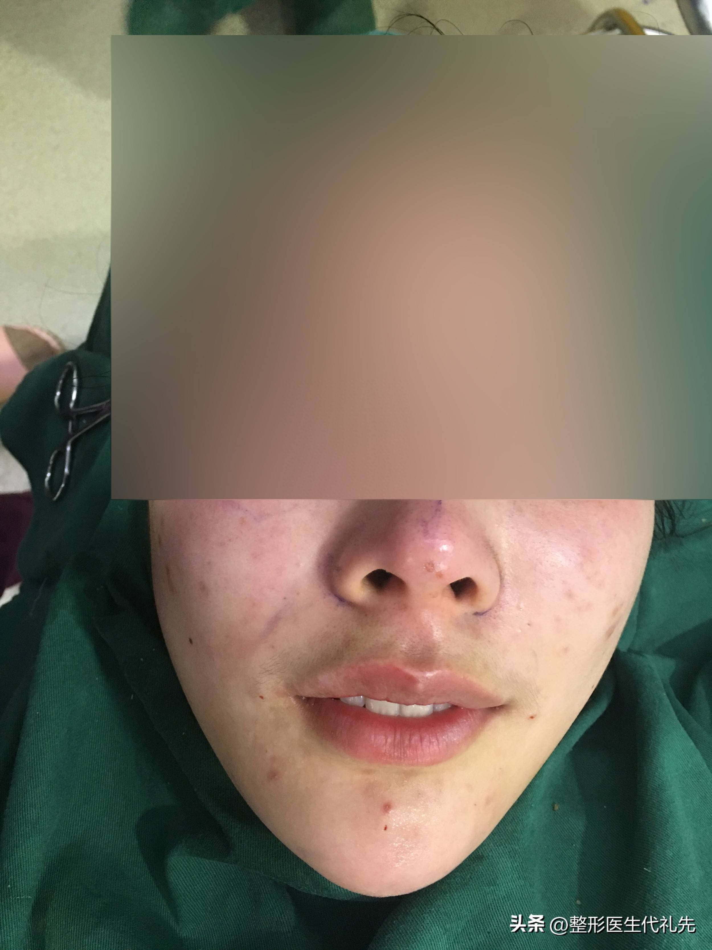 少女针和童颜针的区别，法令纹需要打少女针还是童颜针？_增殖_凝胶_通炎