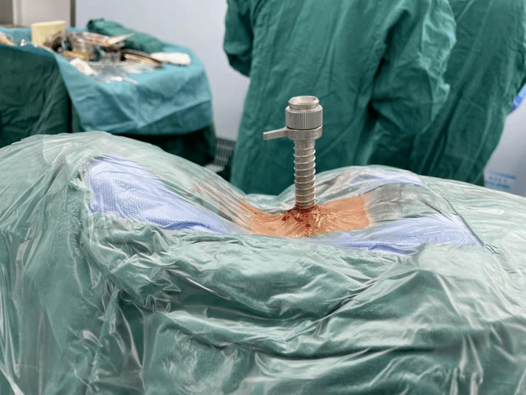 超声刀辅助下减压治疗骨性颈椎间孔狭窄_手术_患者_杨俊松