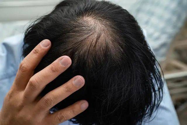 遗传因素:遗传是导致脱发的最常见原因之一