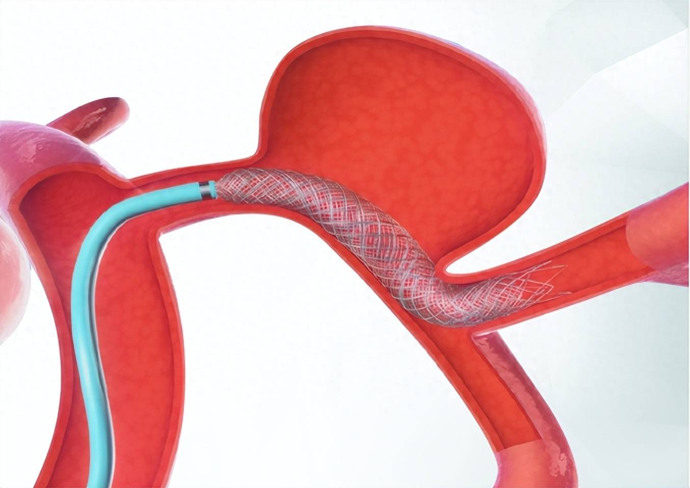 针对颅内动脉瘤,河南省胸科医院开启fred血流导向装置临床使用_患者