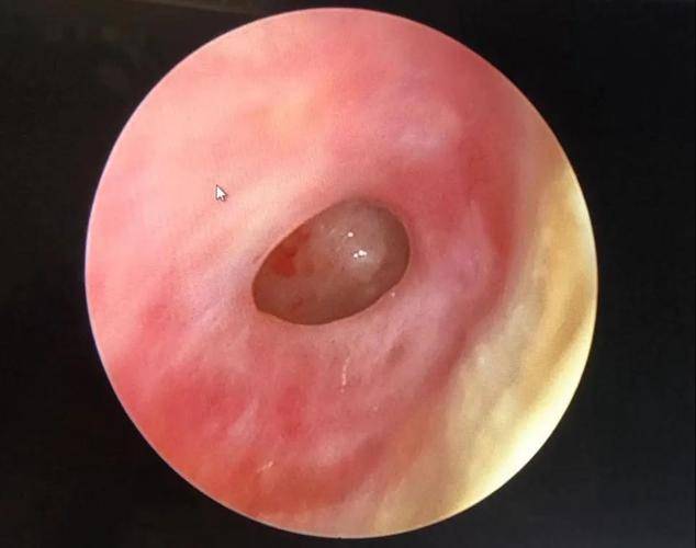 中耳炎引发的鼓膜穿孔,治疗方法有哪些?