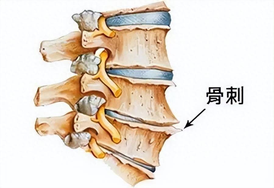 骨质增生会自愈吗图片