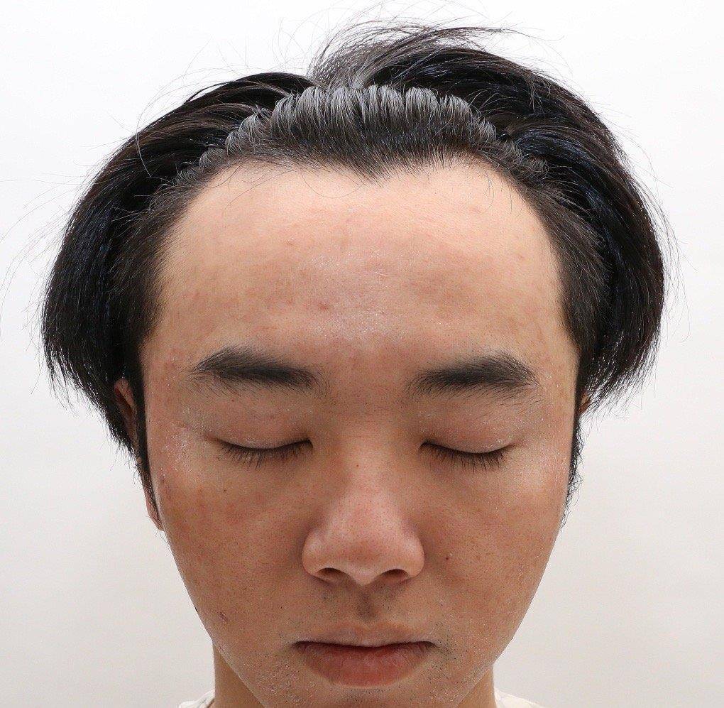 网友称华晨宇是自己老公,还晒出多张华晨宇植发照片,称张碧晨是小三