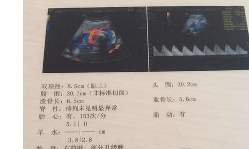 孕检"b超单"上的"4个字"可能对胎儿比较重要,孕妈应提前了解_胎盘