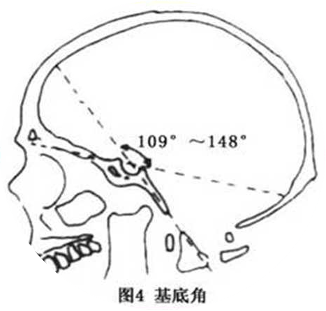 病例科普:术前检查头颅ct平扫发现"颅底凹陷症"_测量_枕骨_形态