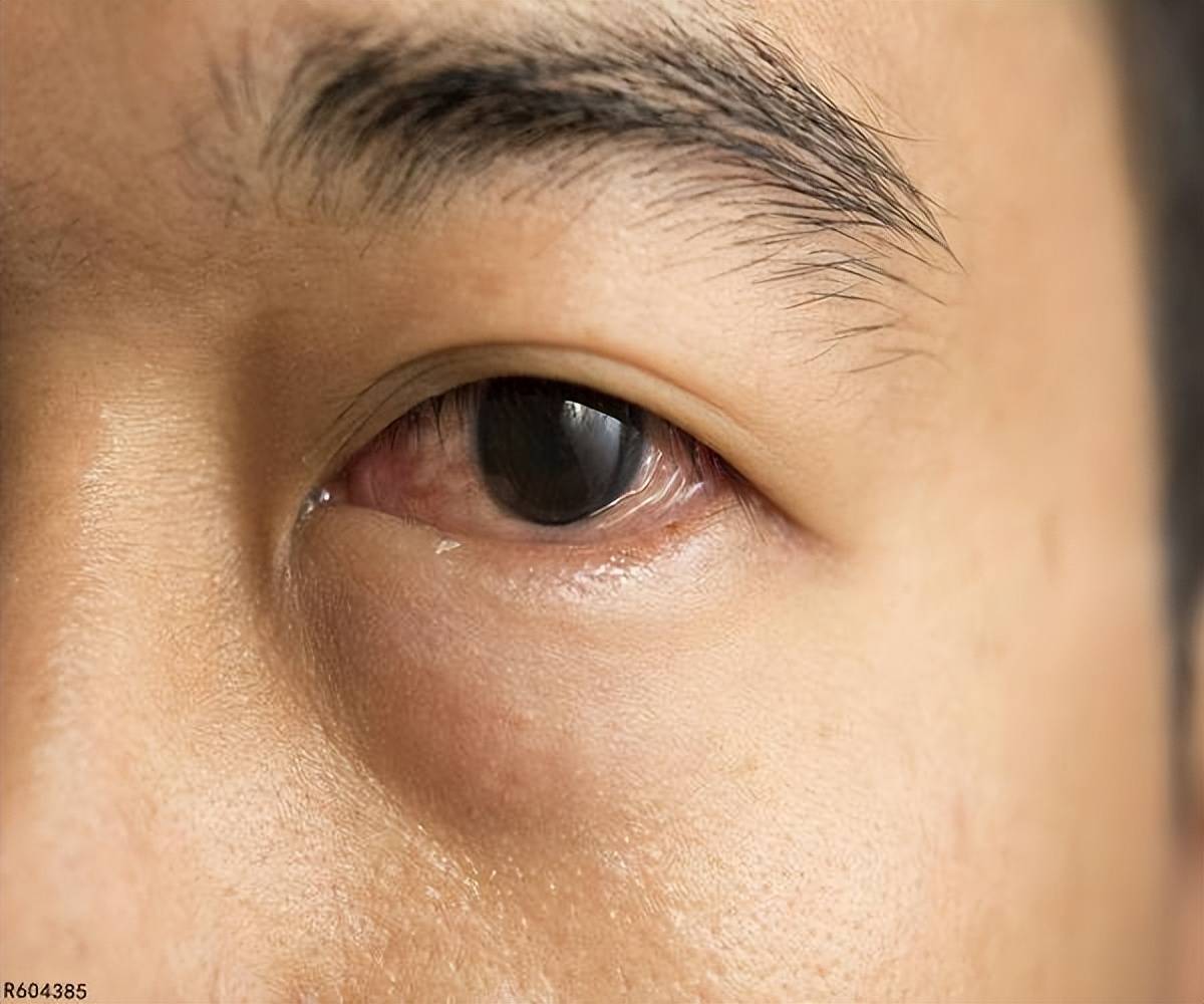 四,白内障糖尿病患者的血糖得不到有效的控制,血糖就会影响到眼睛内部