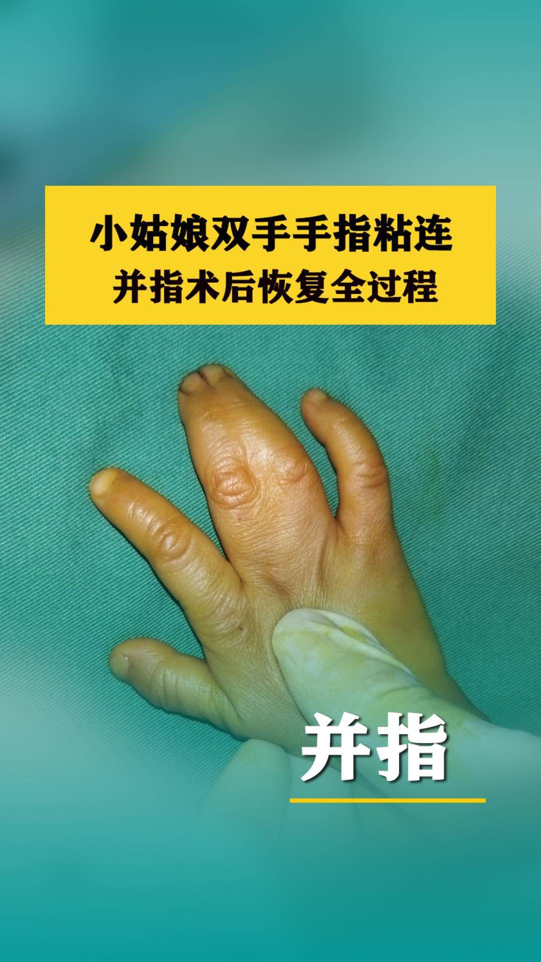 小姑娘双手手指粘连,并指术后恢复过程