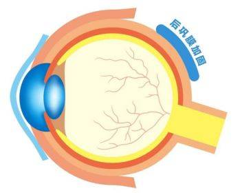 后巩膜加固术是什么?高度近视的你快来了解下!_视网膜_手术_病变